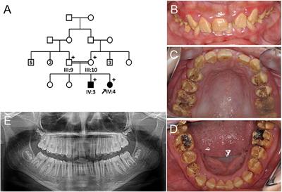 Analyses of MMP20 Missense Mutations in Two Families with Hypomaturation Amelogenesis Imperfecta